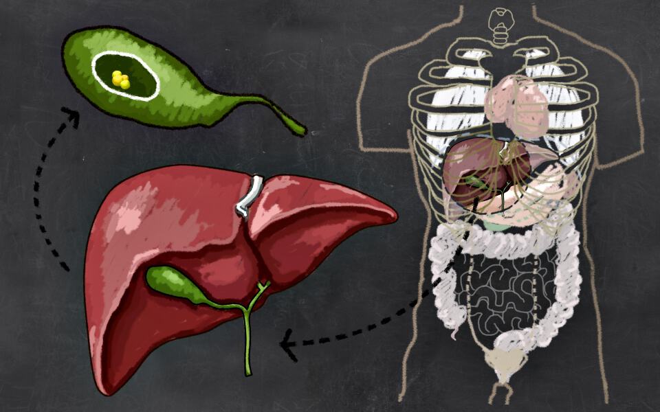 什麼是膽結石？原因、症狀、診斷、治療