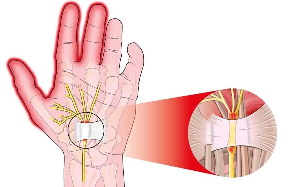 腕隧道症候群手術：風險、過程、術前、術後須知