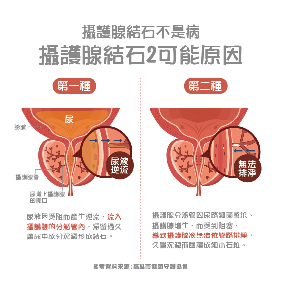 攝護腺鈣化：攝護腺結石和鈣化有關係嗎？