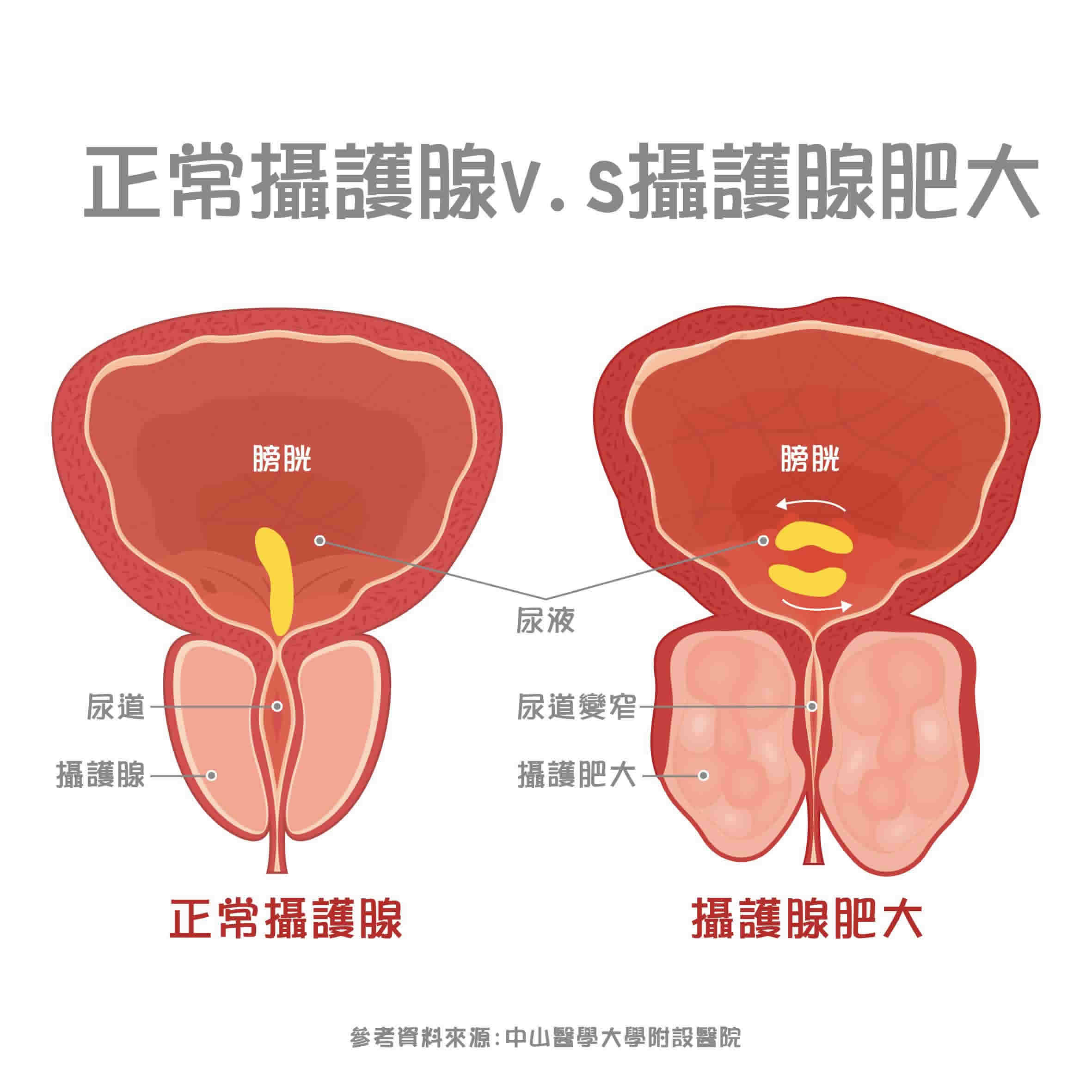 攝護腺肥大5原因！前兆7症狀要注意！治療2大方法一次看