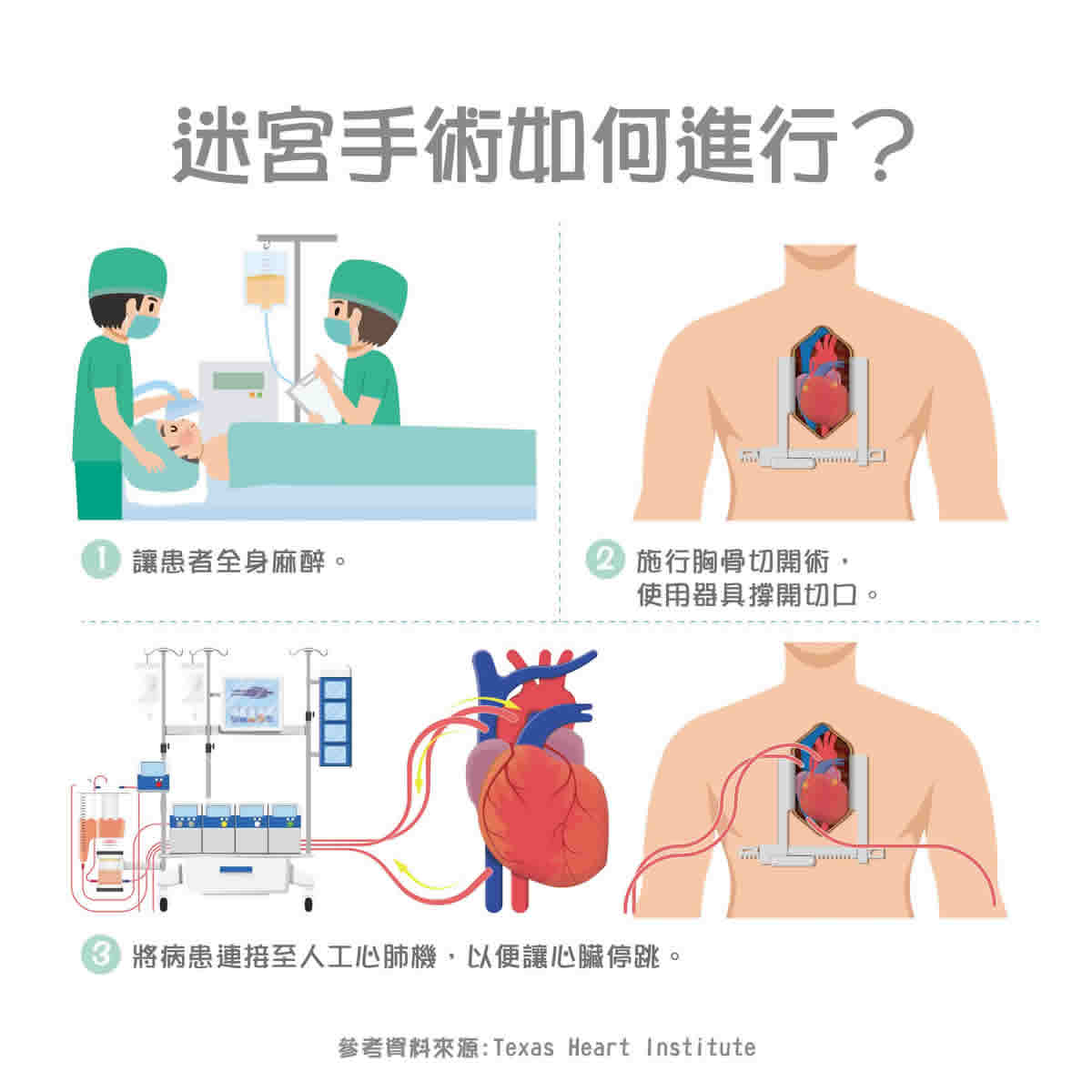 迷宮手術：適用人群、風險因素、手術過程與術後恢復