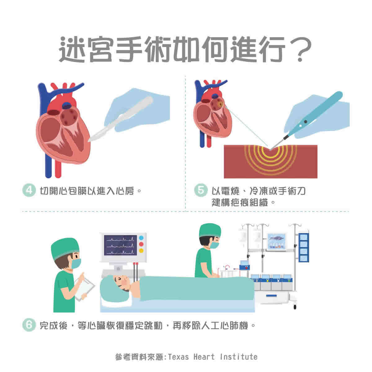 迷宮手術：適用人群、風險因素、手術過程與術後恢復