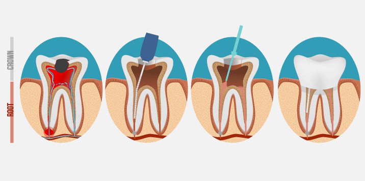 蛀牙抽神經？要做牙套嗎？根管治療的過程與注意事項
