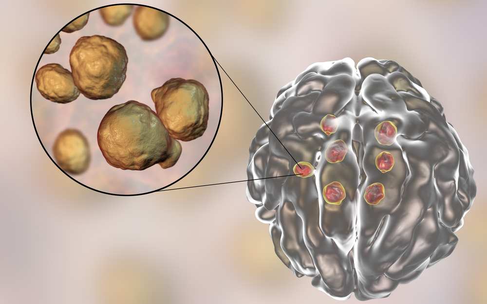 隱球菌病：原因、症狀、診斷、治療
