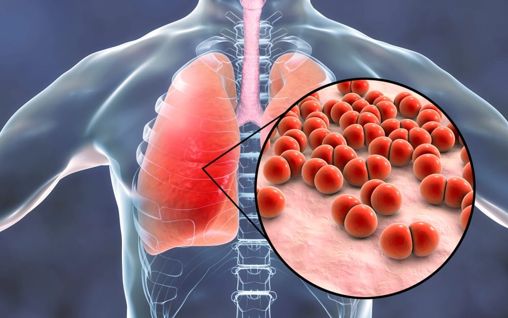 什麼是肺炎？症狀、原因、治療一次看懂