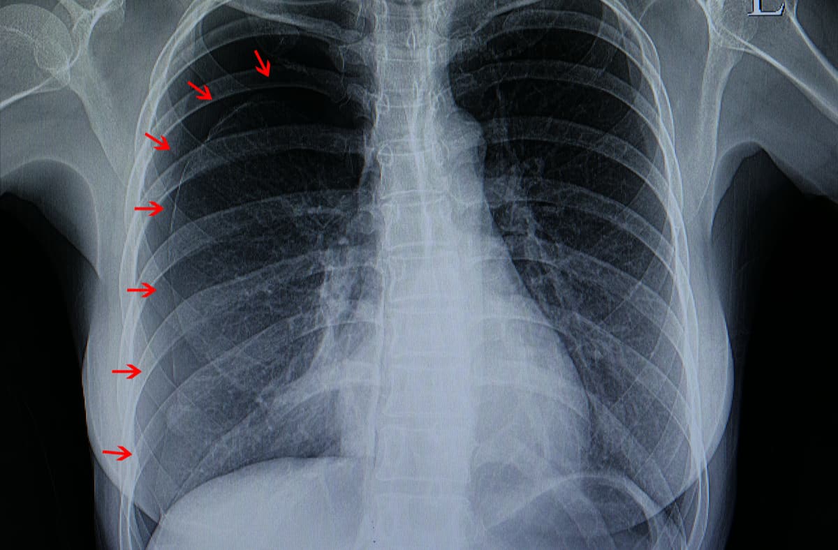 什麼是氣胸？認識症狀、原因、診斷、治療