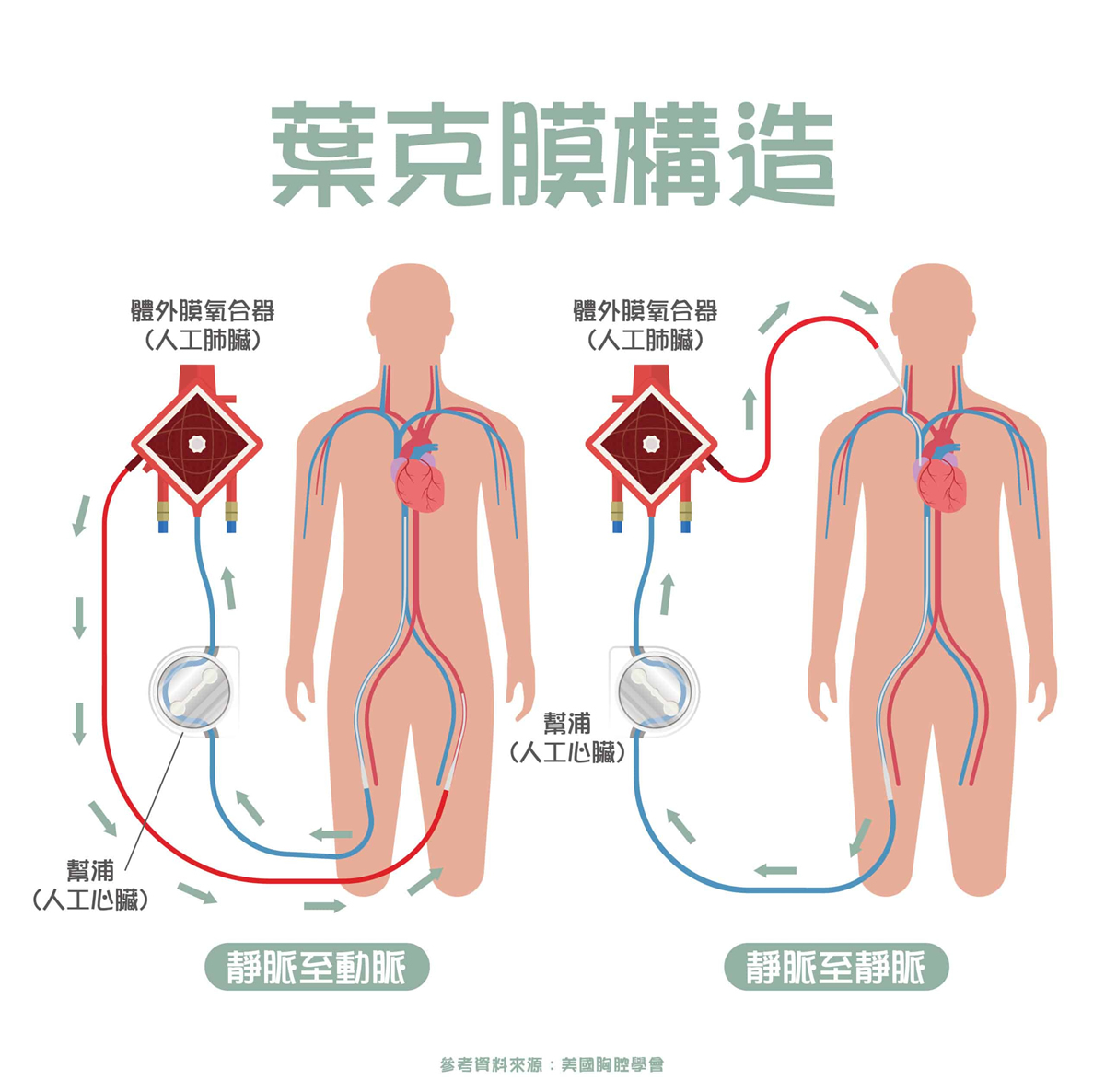 葉克膜是什麼？ECMO的原理、用途、風險、費用