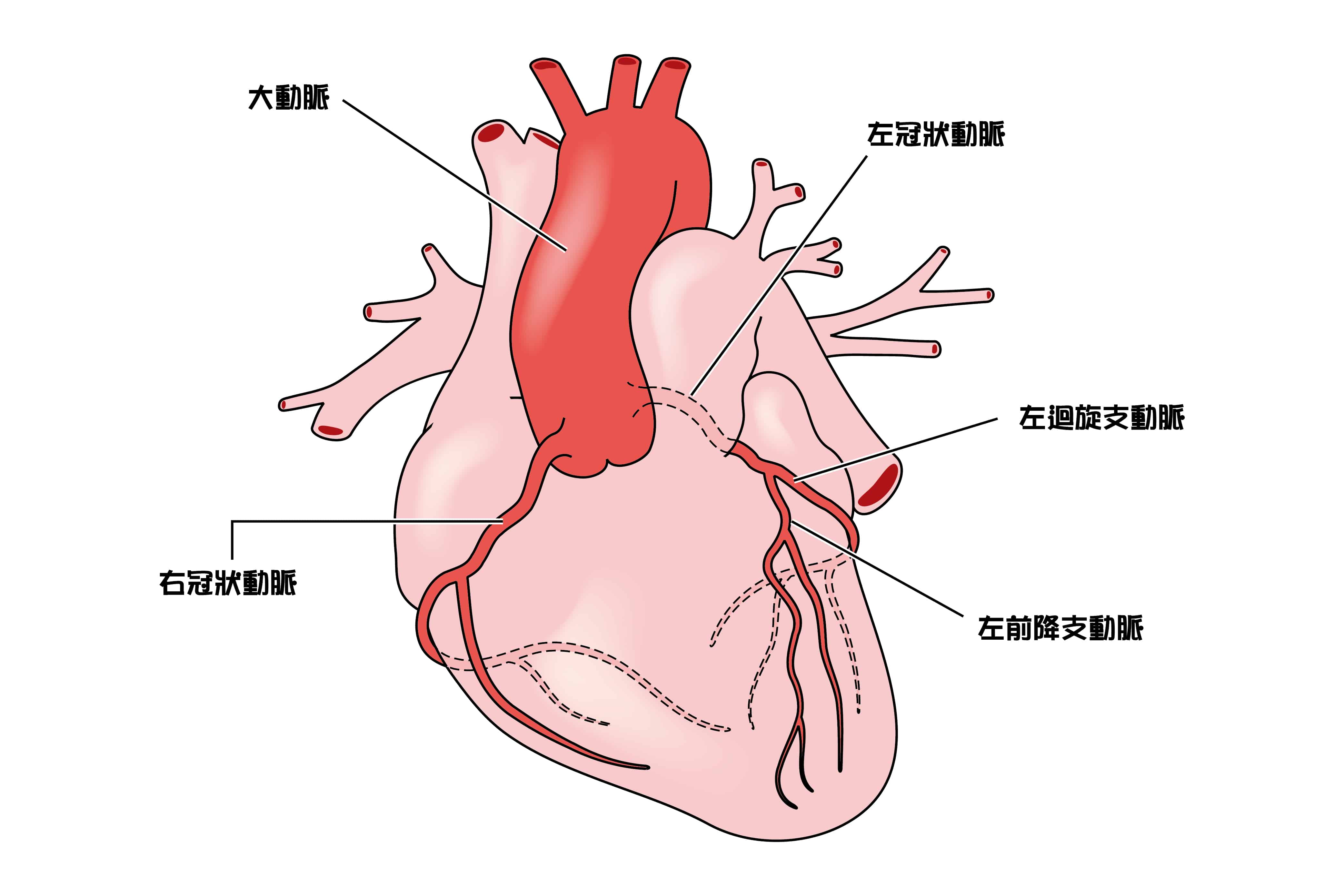 冠狀動脈心臟病｜成因、症狀、診斷、治療、預防