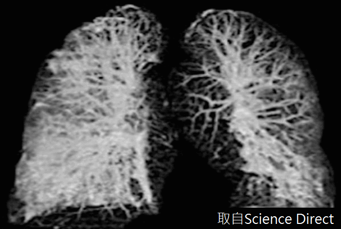 肺部纖維化～新冠肺炎對各器官的影響