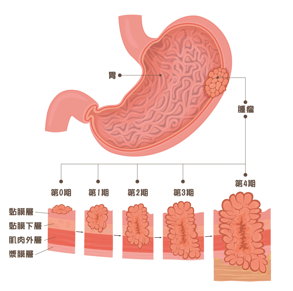認識胃癌