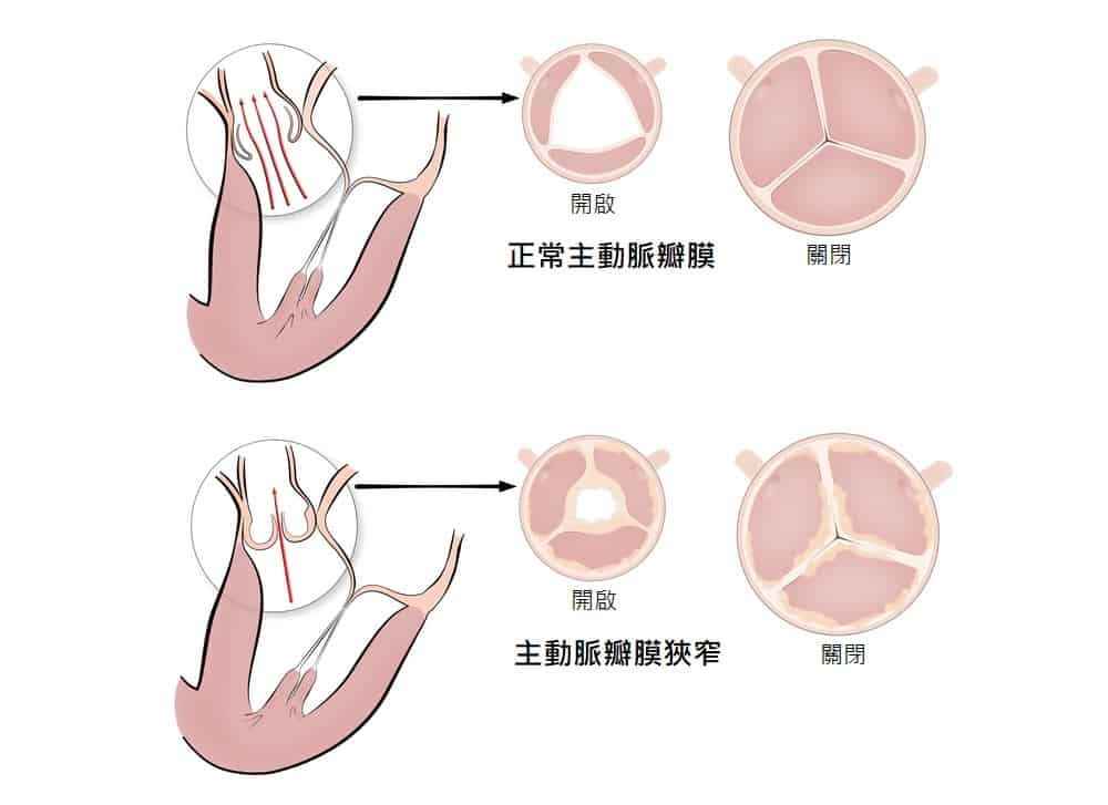 無症狀卻致死率高？了解主動脈瓣狹窄9大風險因子、症狀和治療方式