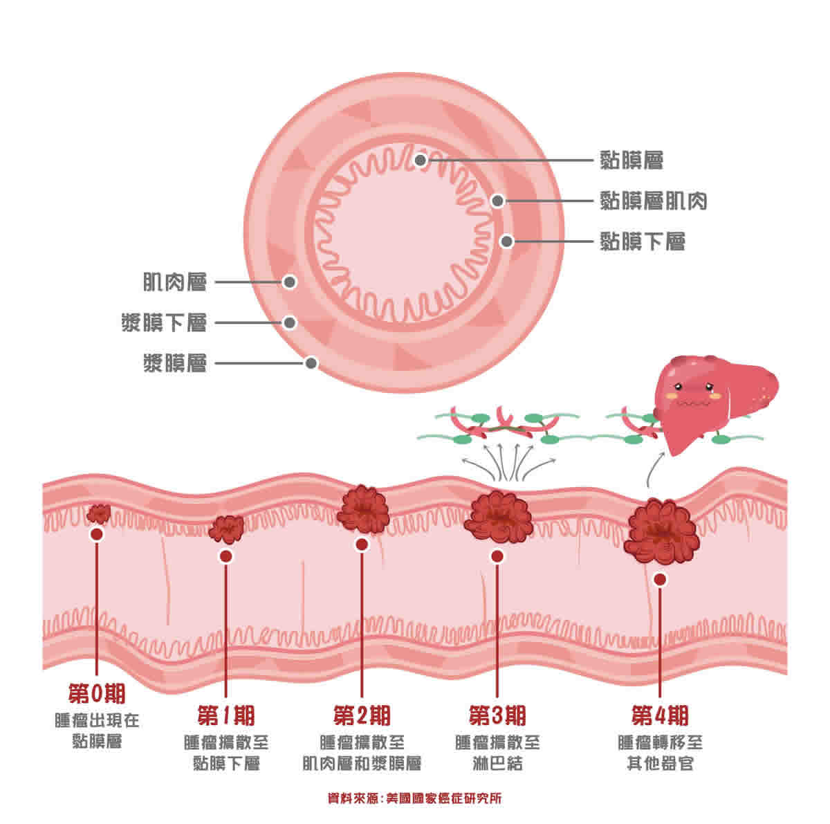 大腸癌分期：TNM分期法0~4期、取決癌細胞擴散程度