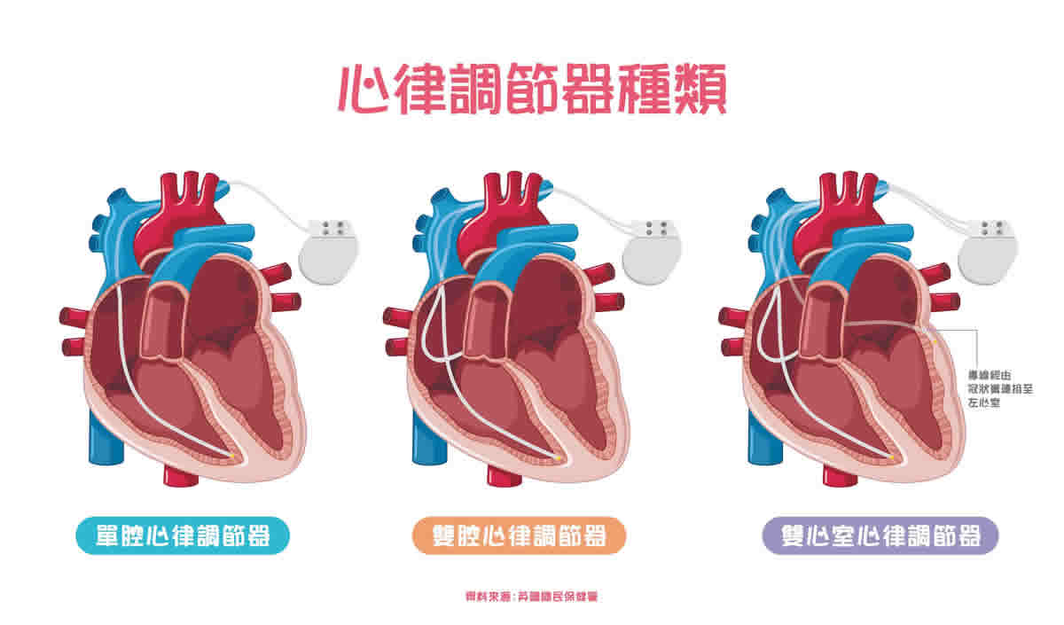 心跳過慢的救星！心律調節器作用與類型介紹