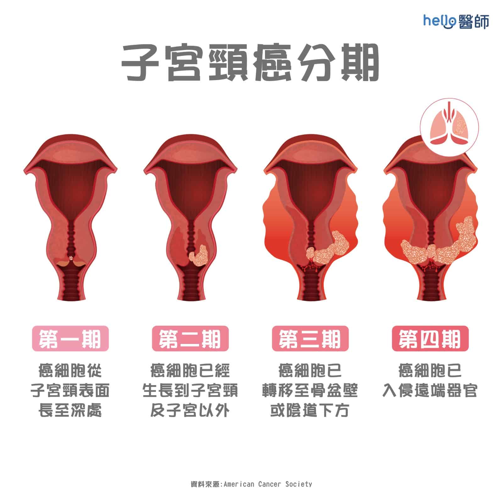 子宮頸癌的分期、轉移與五年存活率