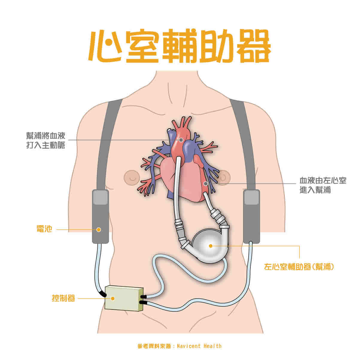 心臟病治療：心臟手術一覽