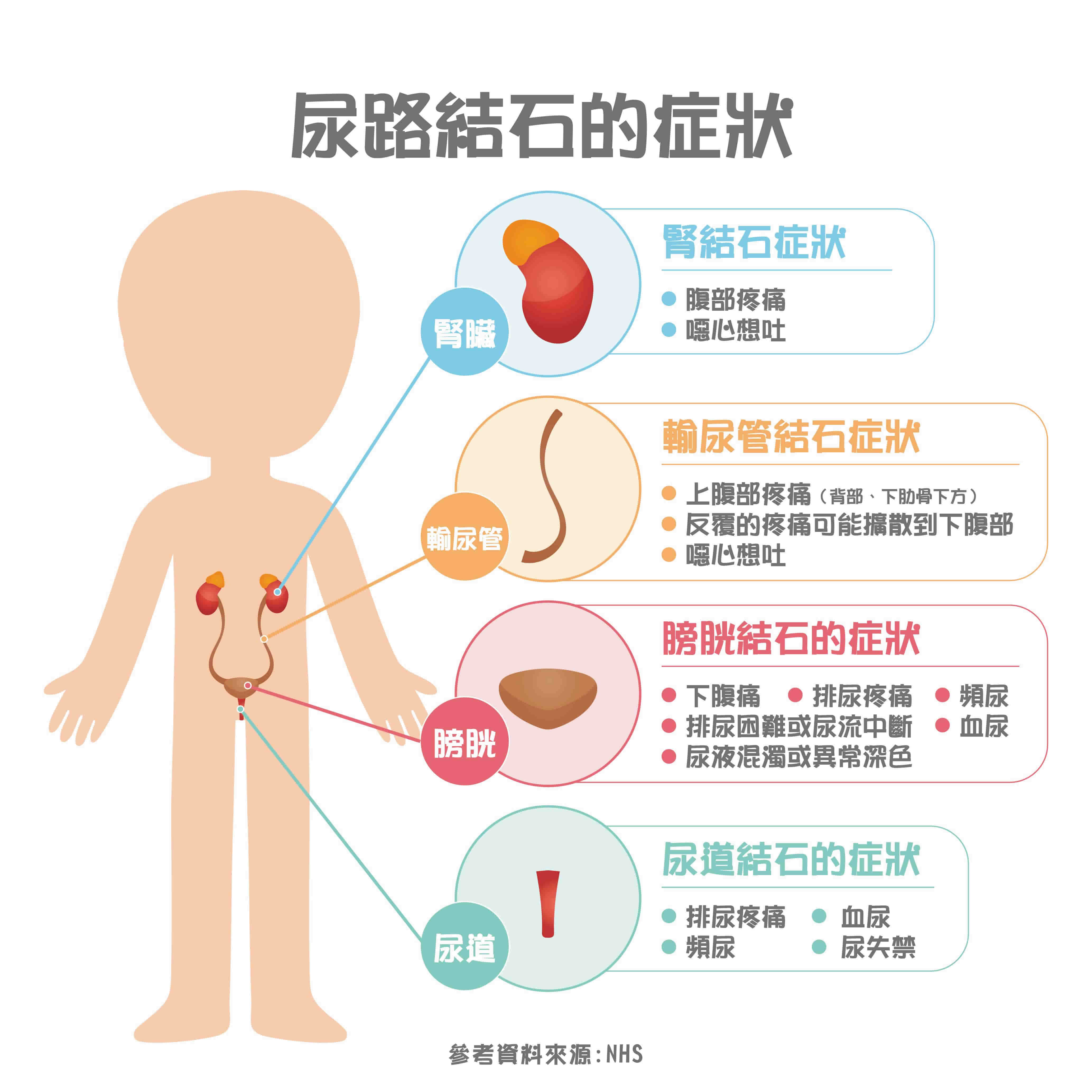 腎結石=尿路結石？尿路結石原因、症狀！5招預防尿結石