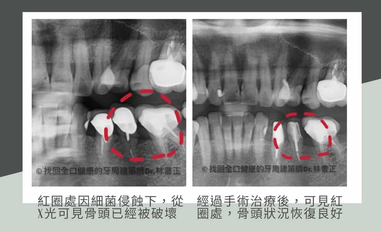 確實刷牙洗牙卻仍牙周病？當心是假牙沒做好清潔