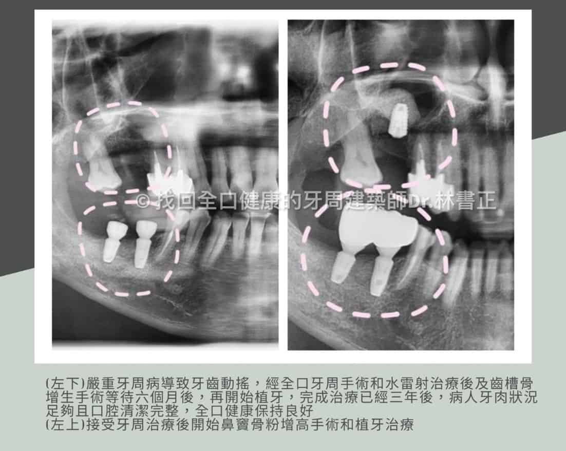 植牙手術前需補骨？齒槽骨萎縮需有骨骼支撐度