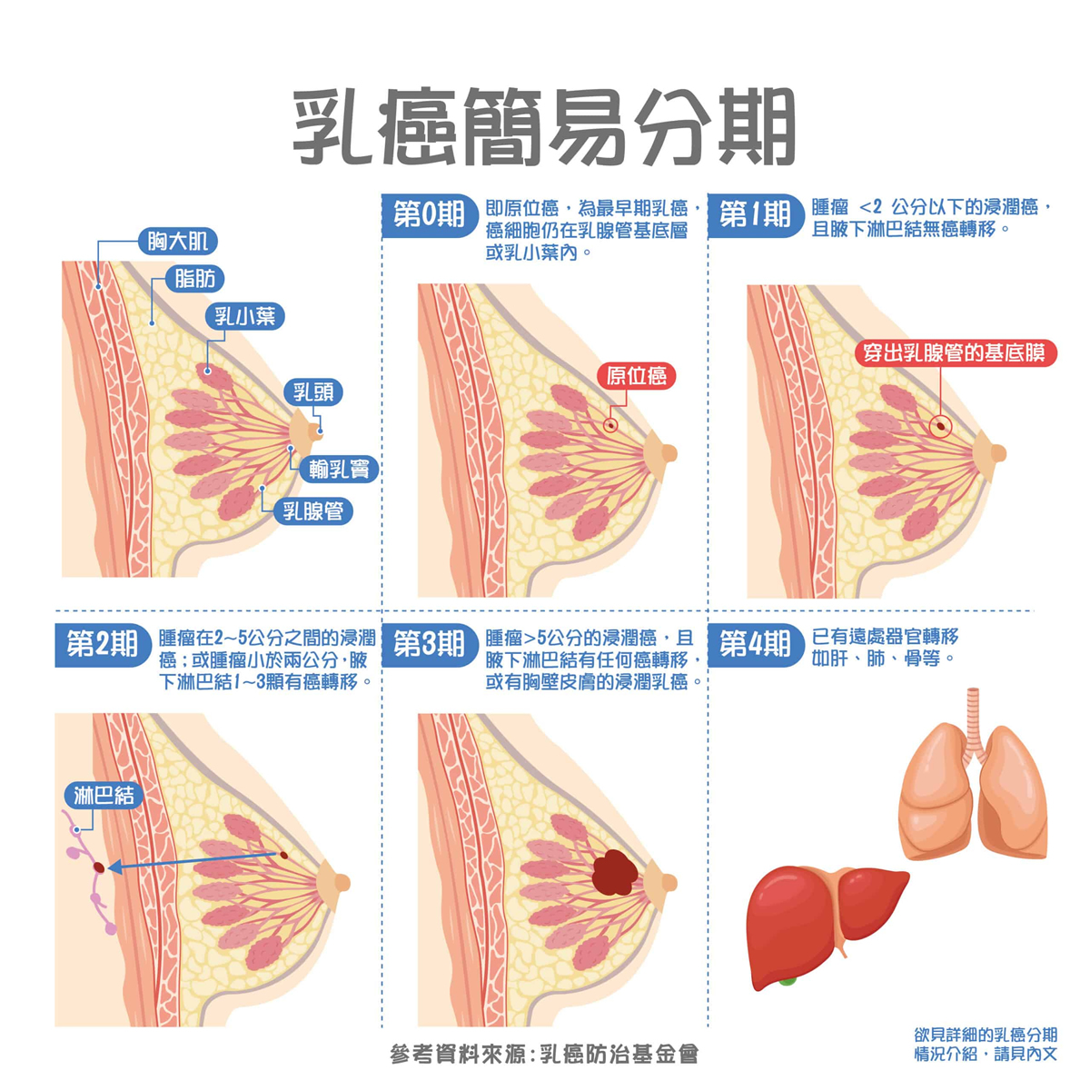 乳癌分期與分類：原位癌與侵入性乳癌