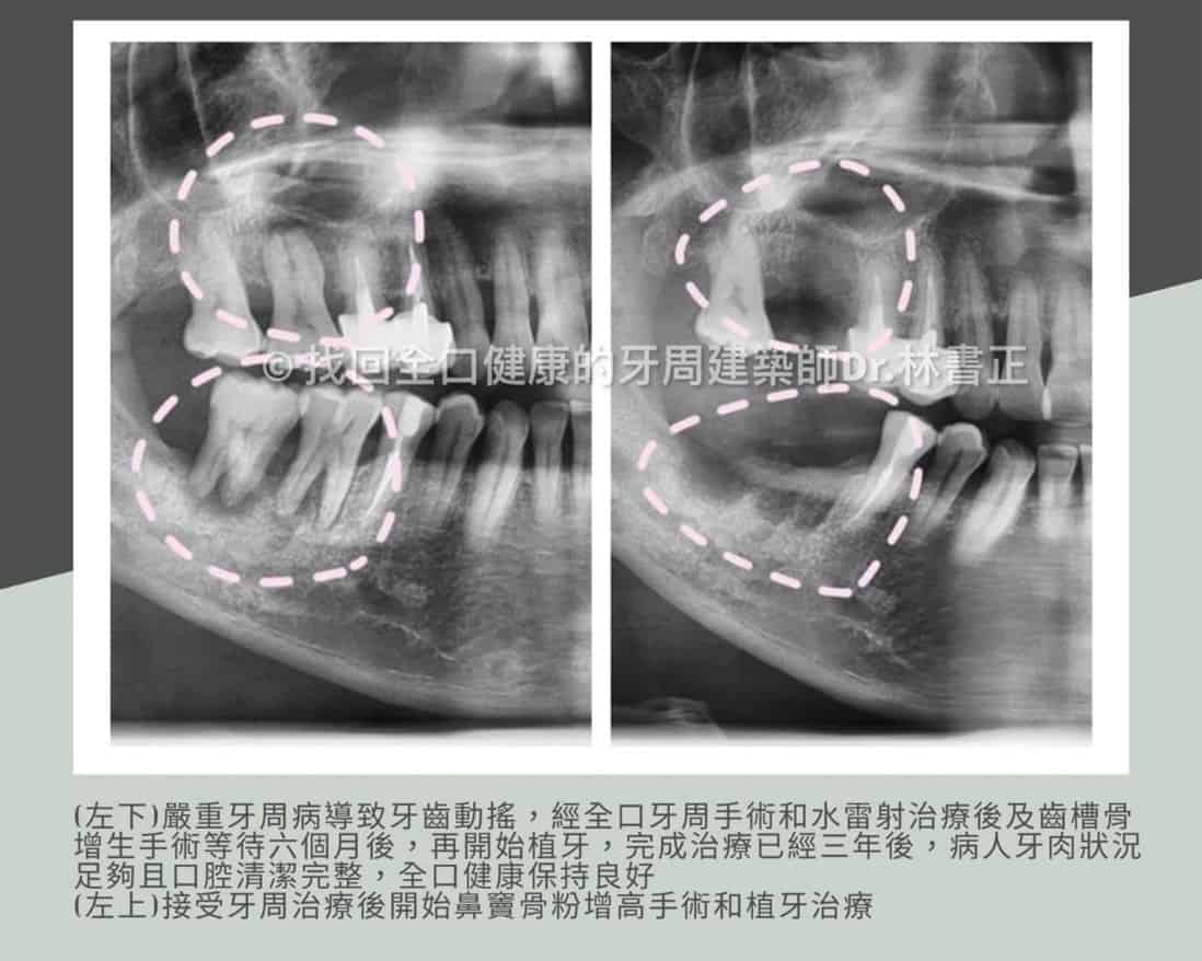 植牙手術前需補骨？齒槽骨萎縮需有骨骼支撐度