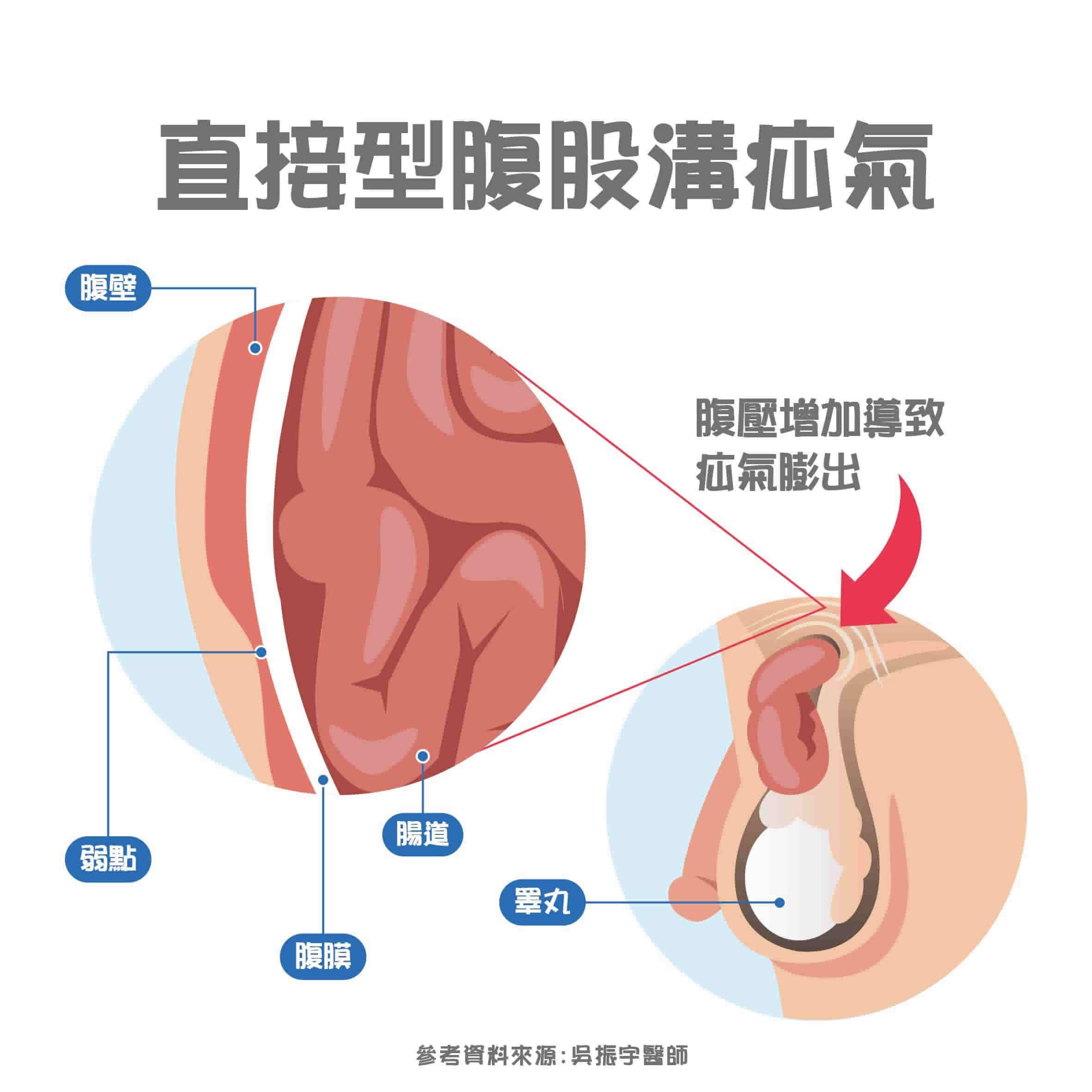 腹股溝疝氣手術怎麼做？手術多久？醫師解析疝氣原因、治療