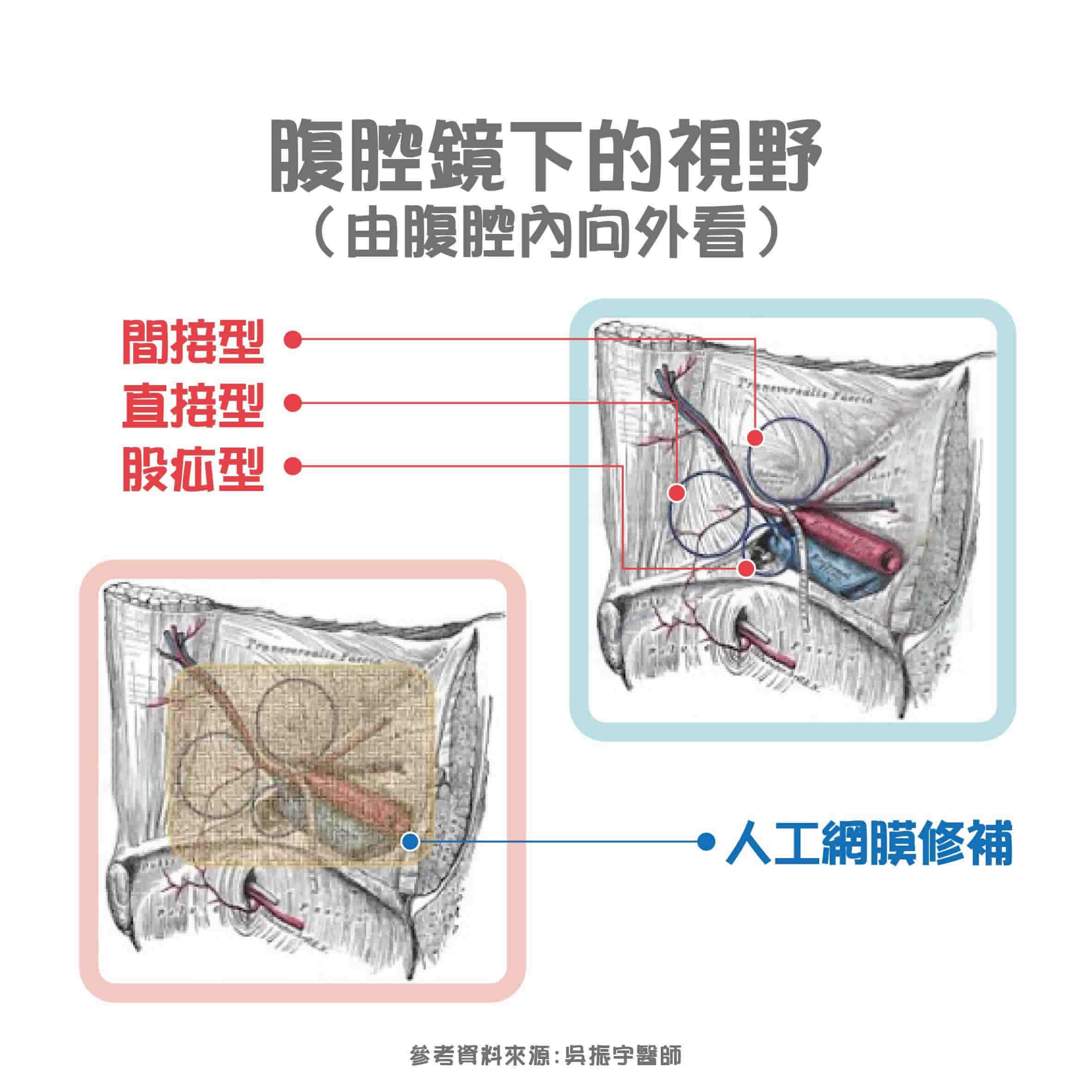 腹股溝疝氣手術怎麼做？手術多久？醫師解析疝氣原因、治療