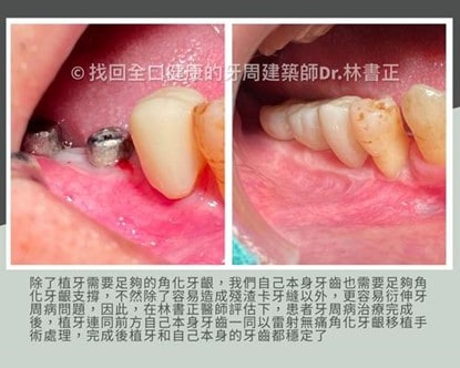 牙肉不足影響植牙！植牙手術前先做好牙齦補肉