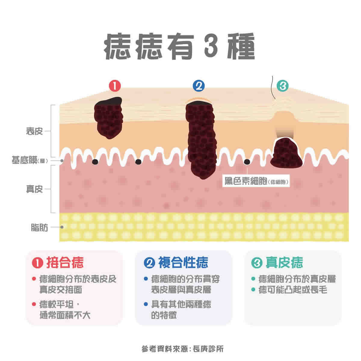 痣變大、痣多或長毛會變皮膚癌？認識痣的形成與原因