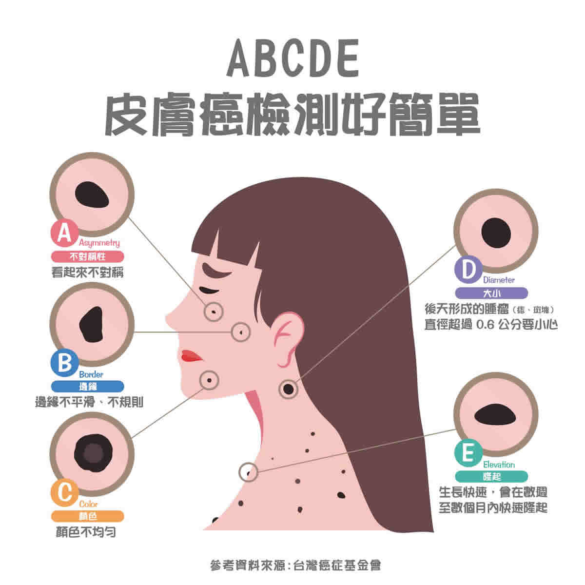 痣變大、痣多或長毛會變皮膚癌？認識痣的形成與原因