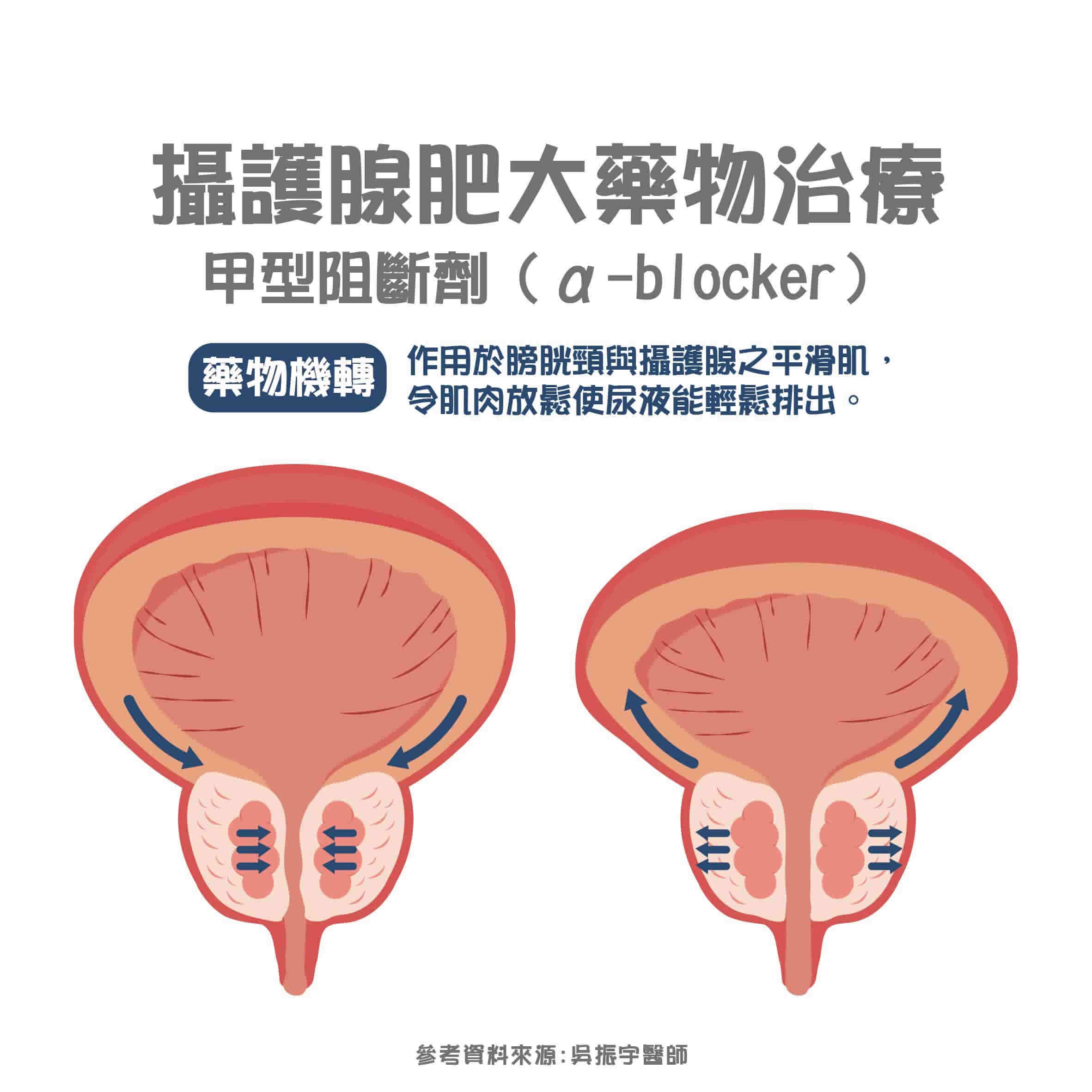 攝護腺肥大可靠吃藥改善？良性攝護腺肥大治療藥物介紹