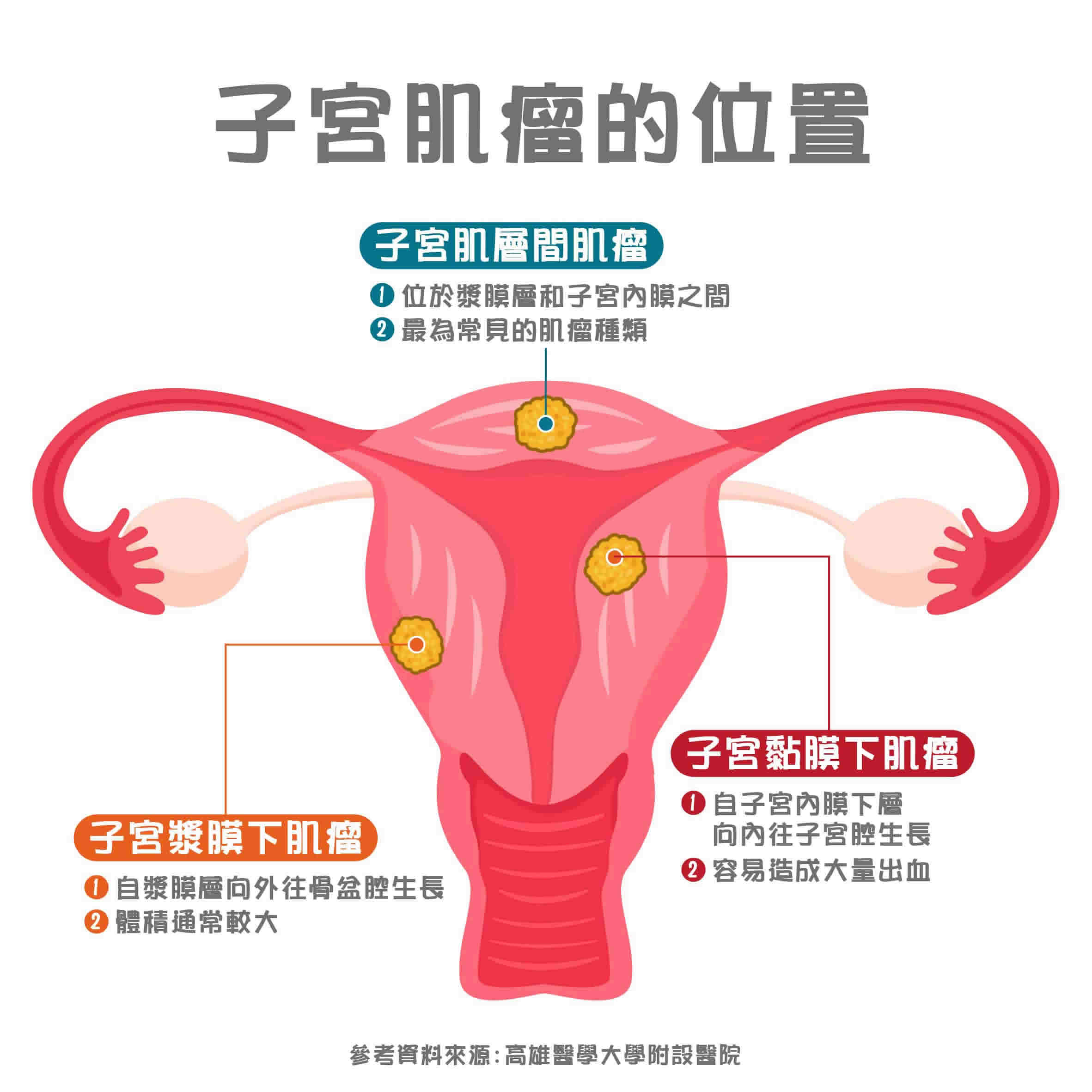 子宮肌瘤症狀？治療要手術？詳解子宮肌瘤原因、檢查