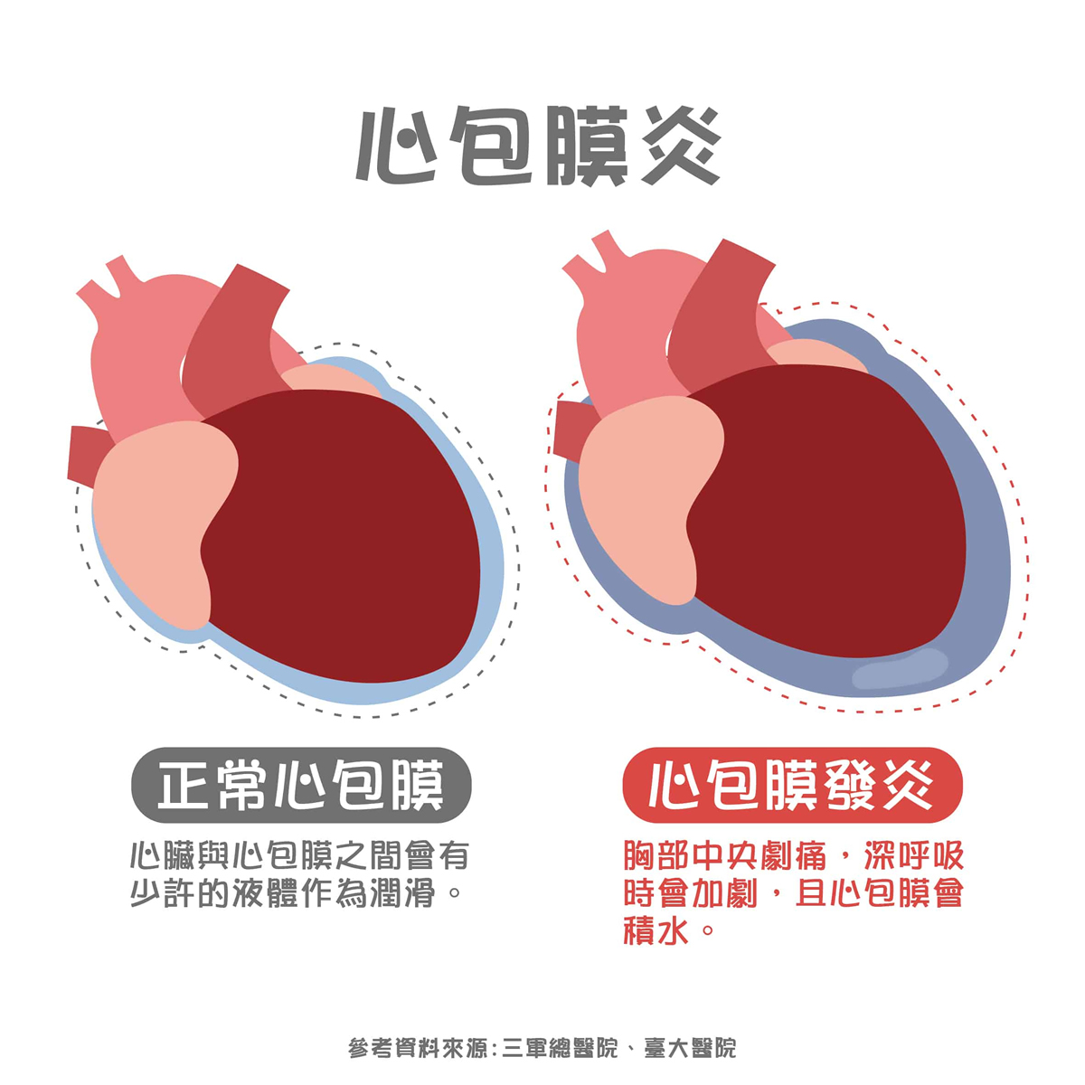 心包膜炎原因？急性、慢性心包炎症狀？心包膜炎治療解析