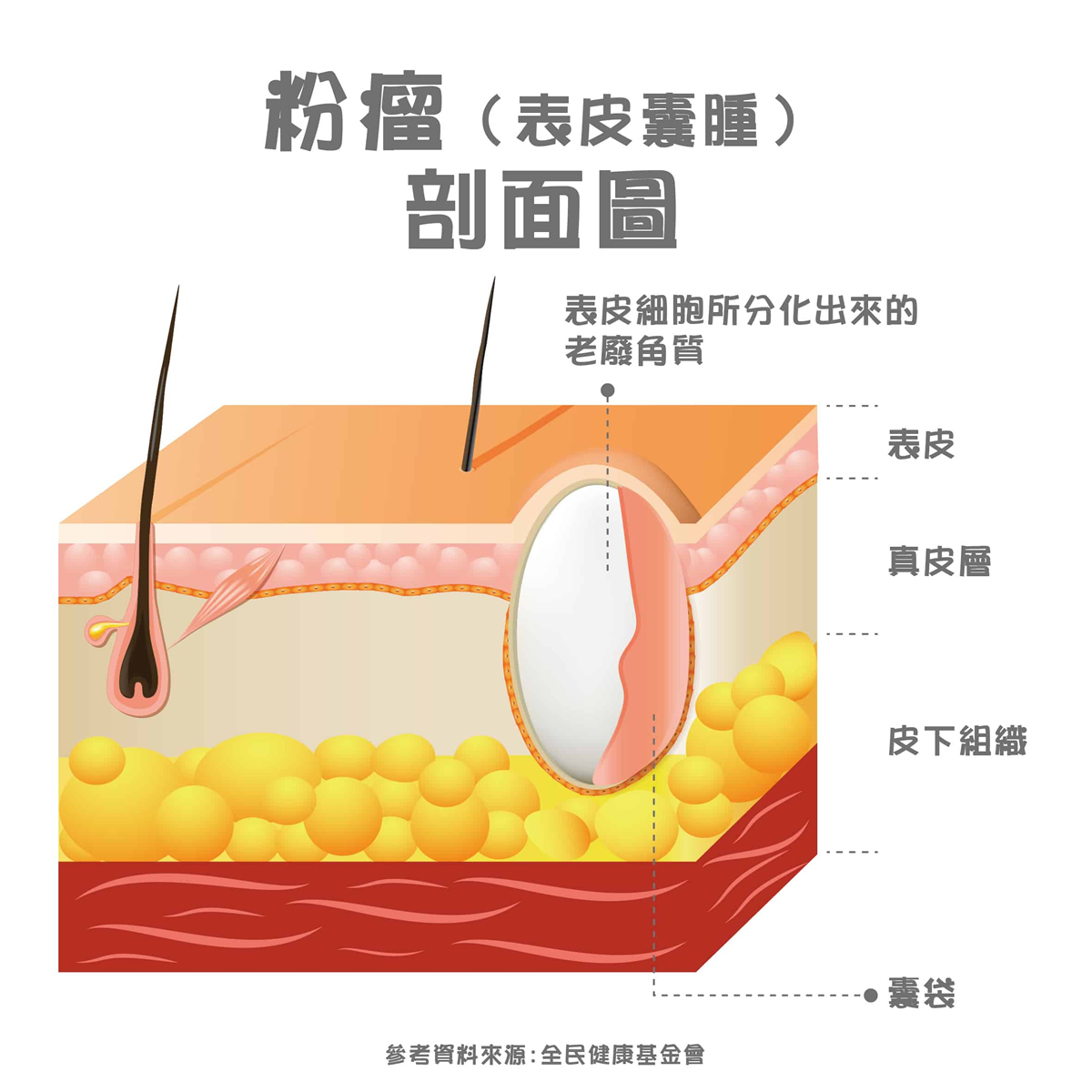 粉瘤粉刺差在哪、手術可根治？告別粉瘤先注意這些