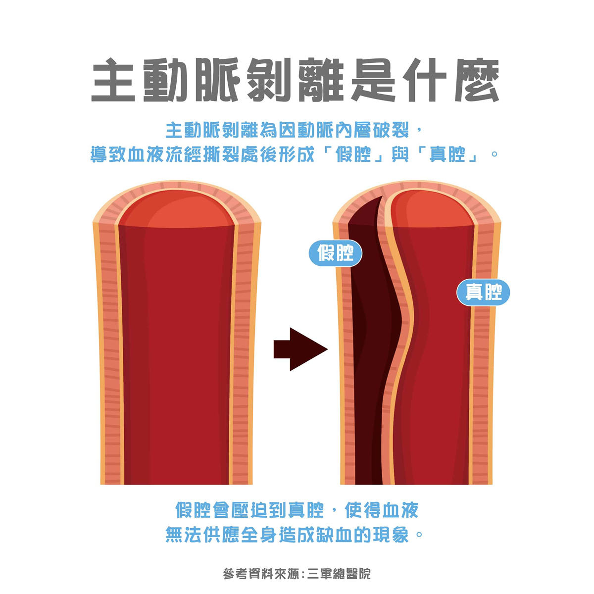 劇烈胸痛要小心！解析主動脈剝離原因、先兆及症狀，掌握4招有效預防