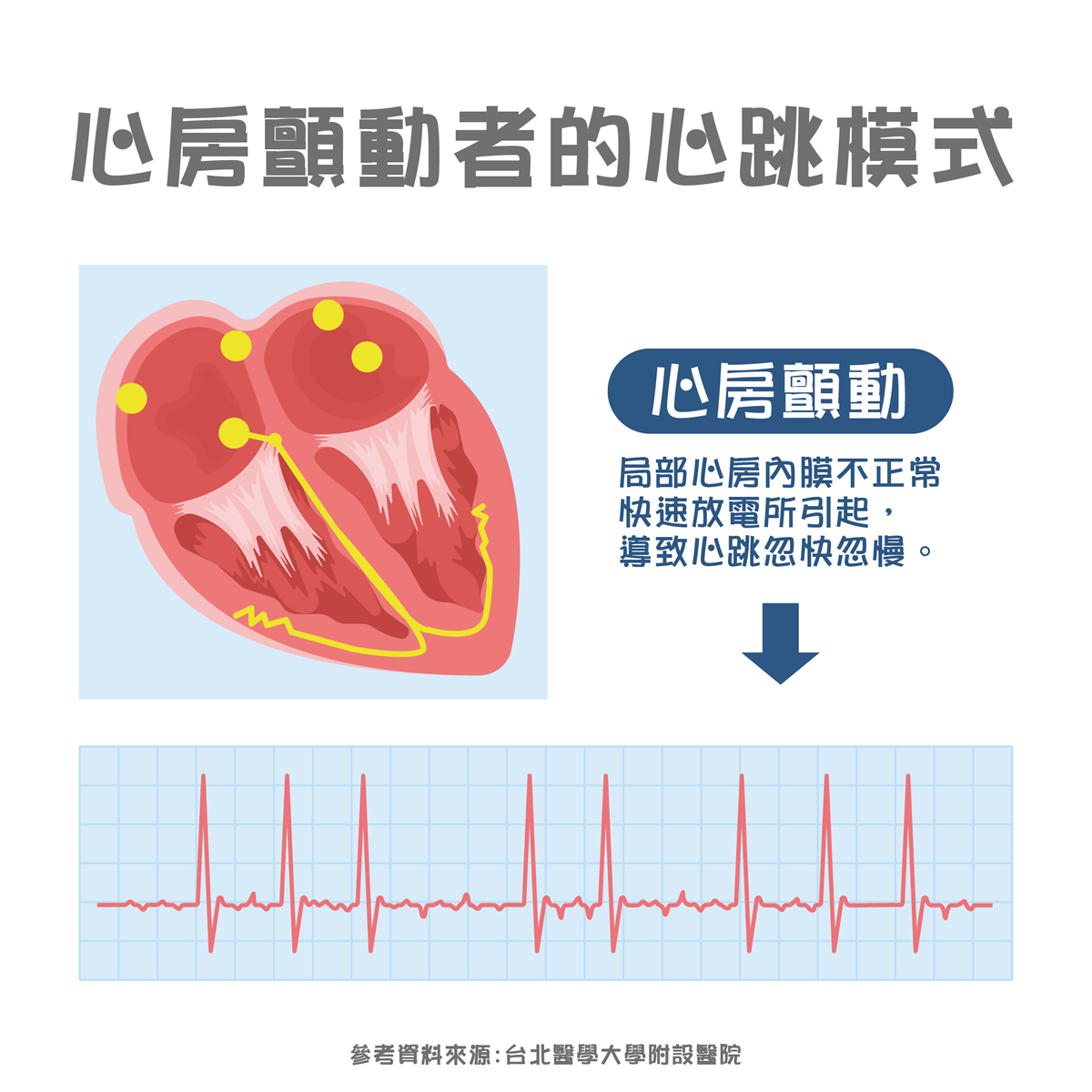 心房顫動有什麼感覺？認識心房顫動症狀、治療及併發症