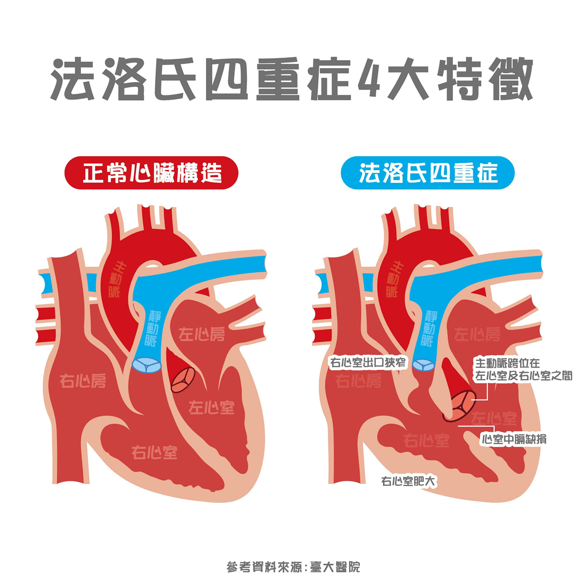 嬰兒身體發藍快就醫！法洛氏四重症的死亡率高，現今手術成功率達9成