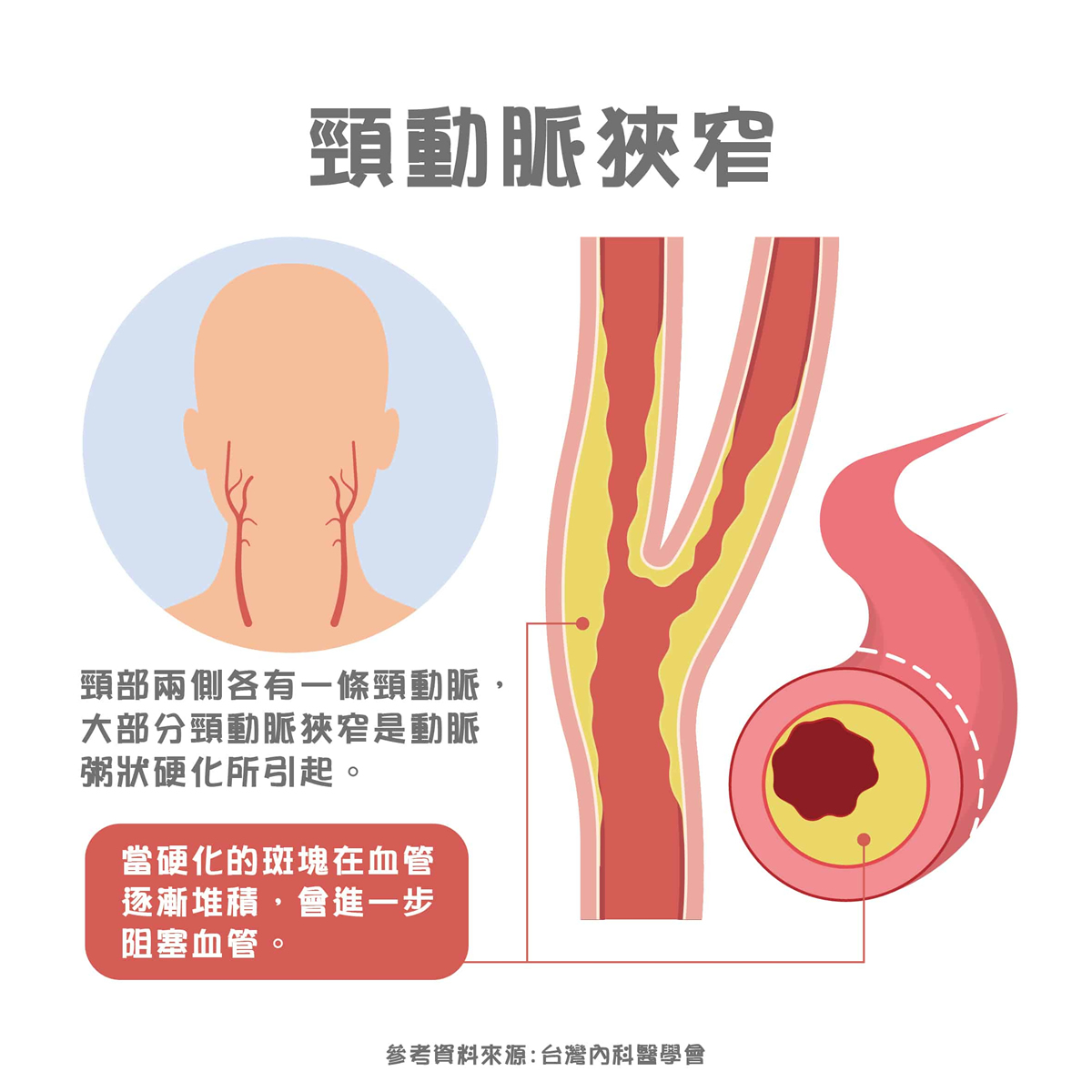 頭暈、眼睛模糊竟中風？頸動脈狹窄7大前兆、改善方法一次看