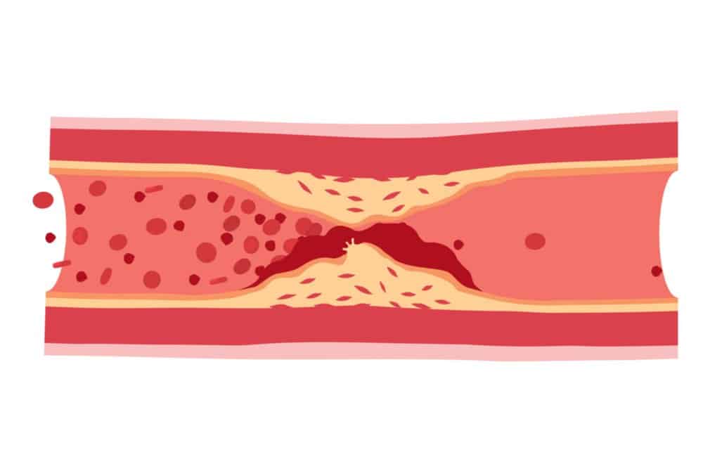 動脈粥狀硬化是什麼？動脈硬化原因、症狀、診斷及治療解析