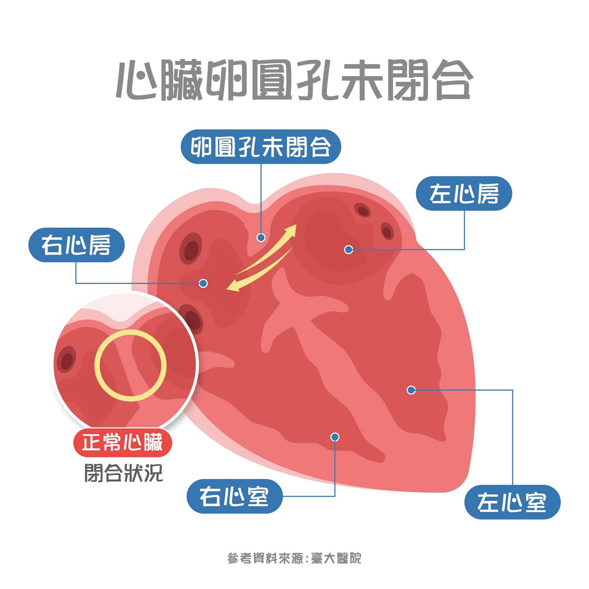 心臟「破個洞」！你家寶貝也有嗎？認識卵圓孔未閉合症狀與治療