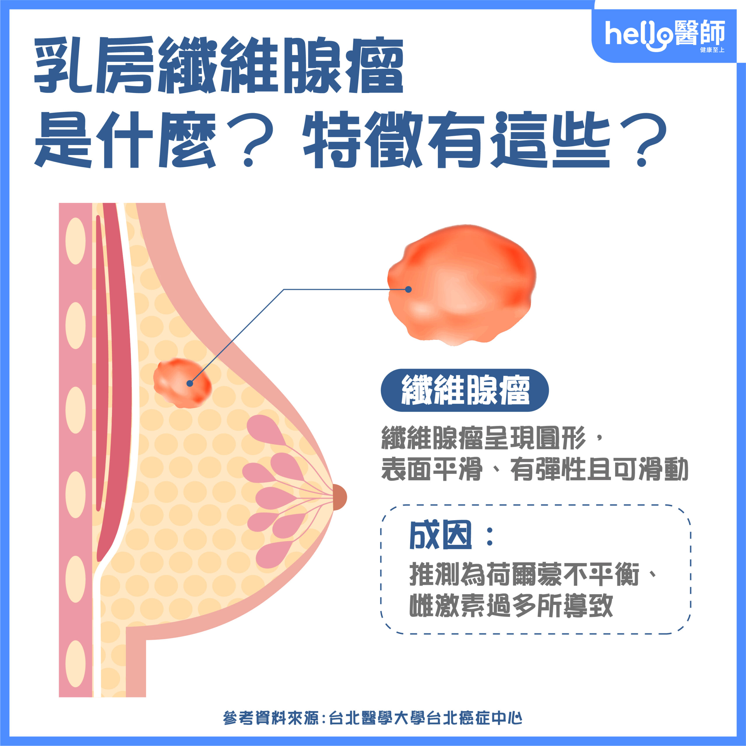 乳房纖維腺瘤是什麼？與乳癌腫塊差異？症狀特徵、原因解析