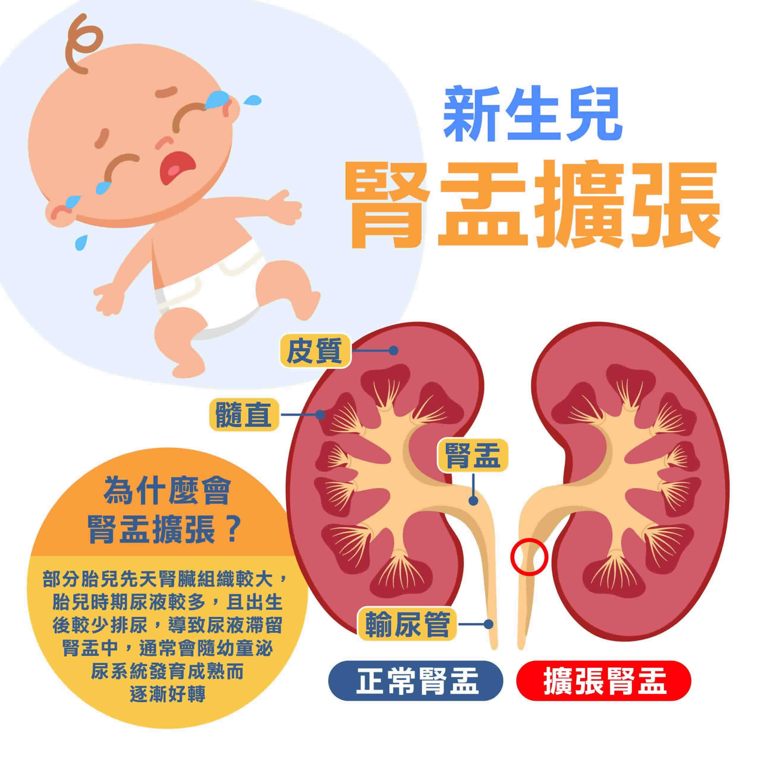 新生兒腎盂擴張別慌張，定期接受腎臟超音波檢查就OK！