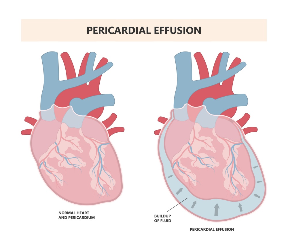 心包膜積水是什麼？為什麼心臟會積水？解說心包膜積水症狀與治療