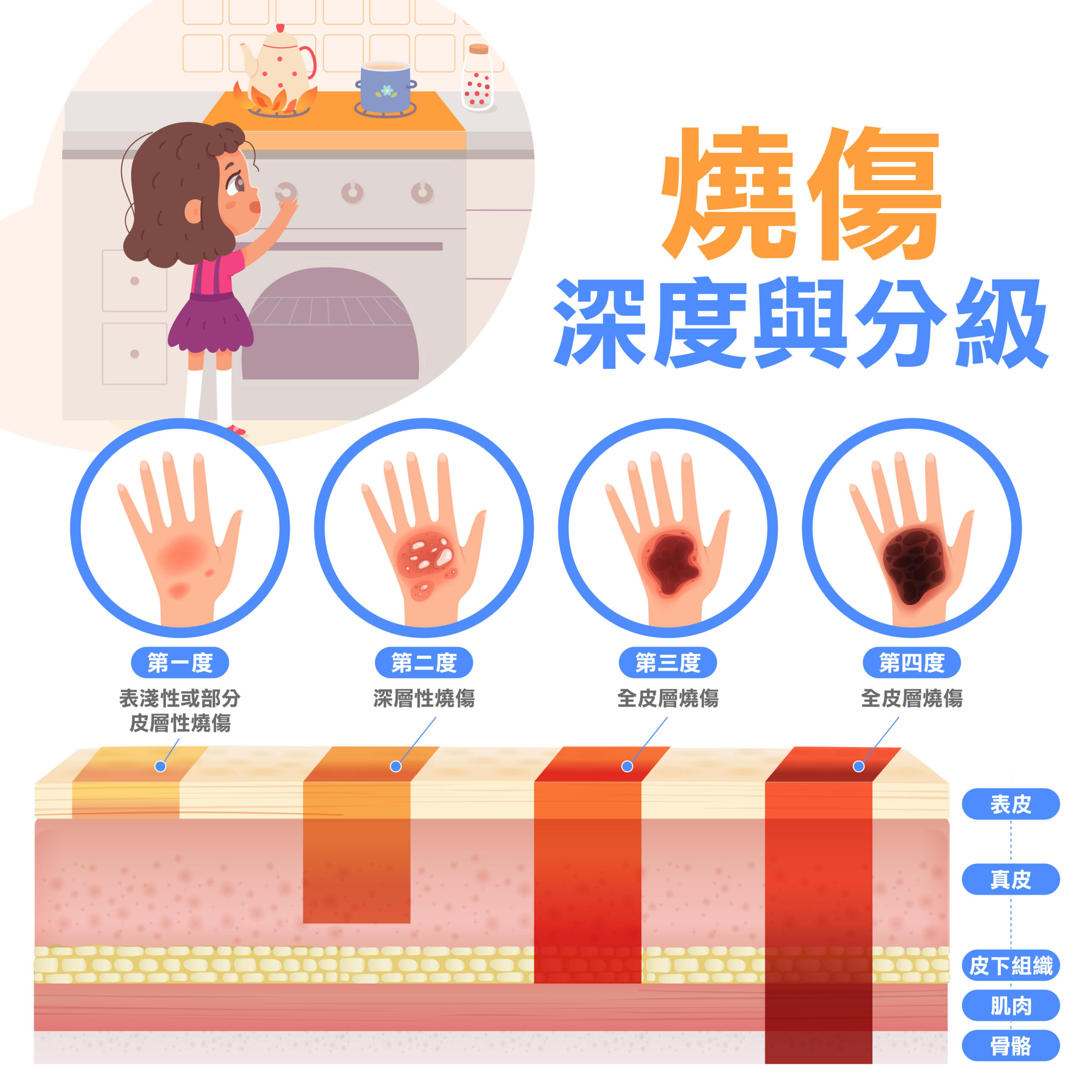 燙傷起水泡怎麼辦？多久會消？4步驟處理燙傷水泡