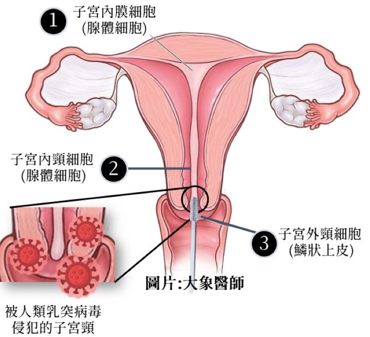 子宮頸抹片檢查前必看！6大注意事項、報告怎麼看？異常原因一次看