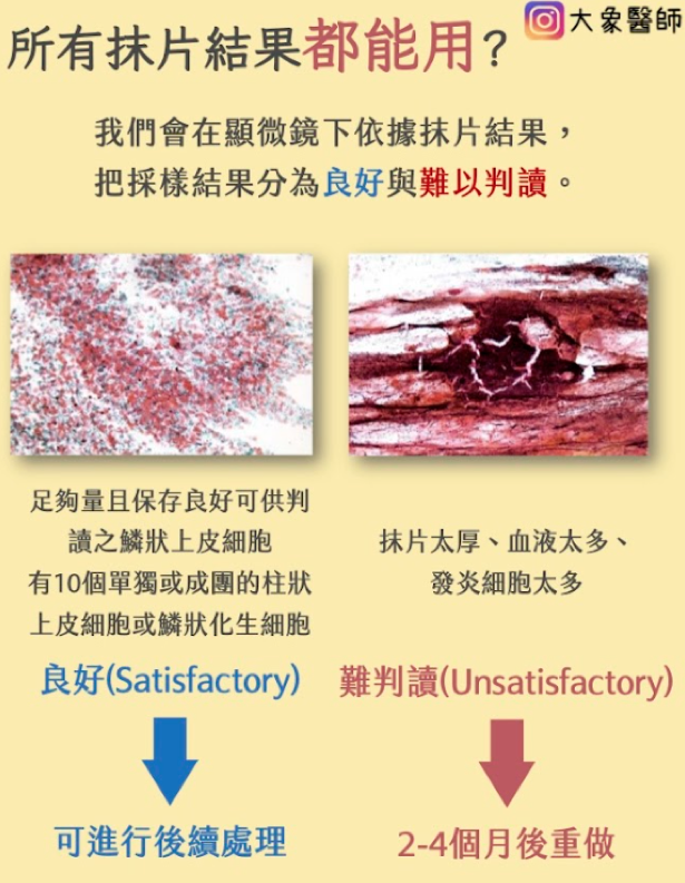 子宮頸抹片檢查前必看！6大注意事項、報告怎麼看？異常原因一次看