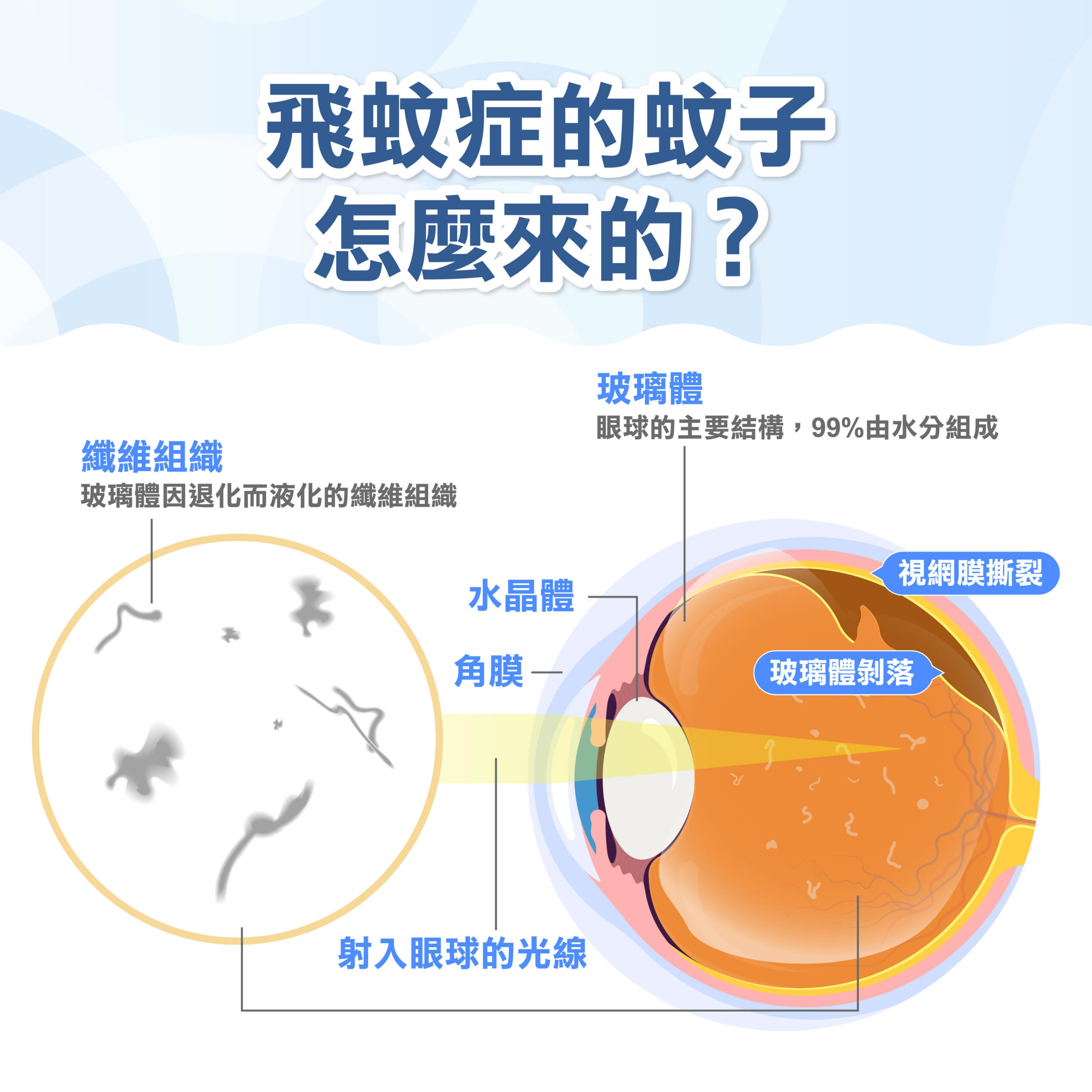 飛蚊症不治療會好嗎？飛蚊症原因、初期症狀、改善治療全攻略