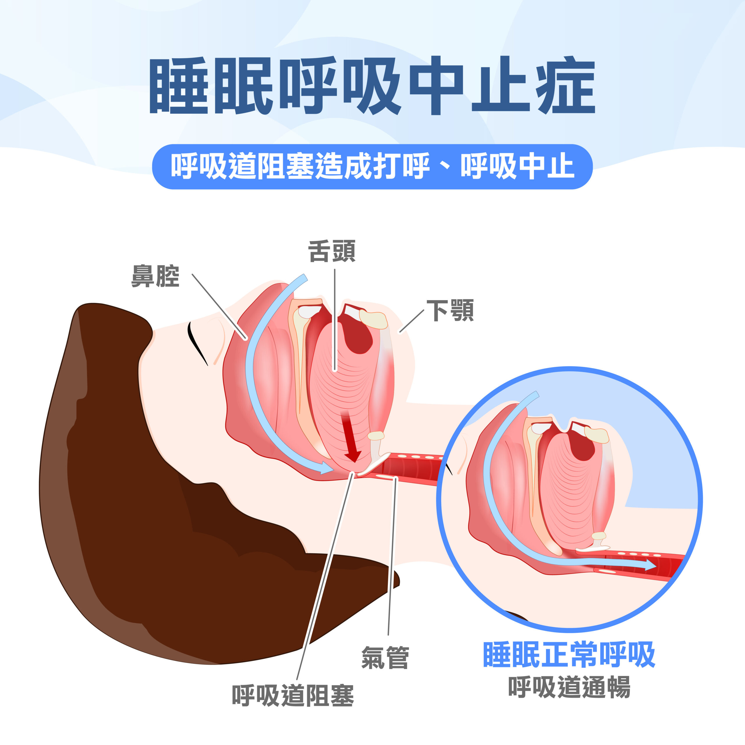 睡眠呼吸中止症14症狀！治療看哪科？3大原因、4招改善