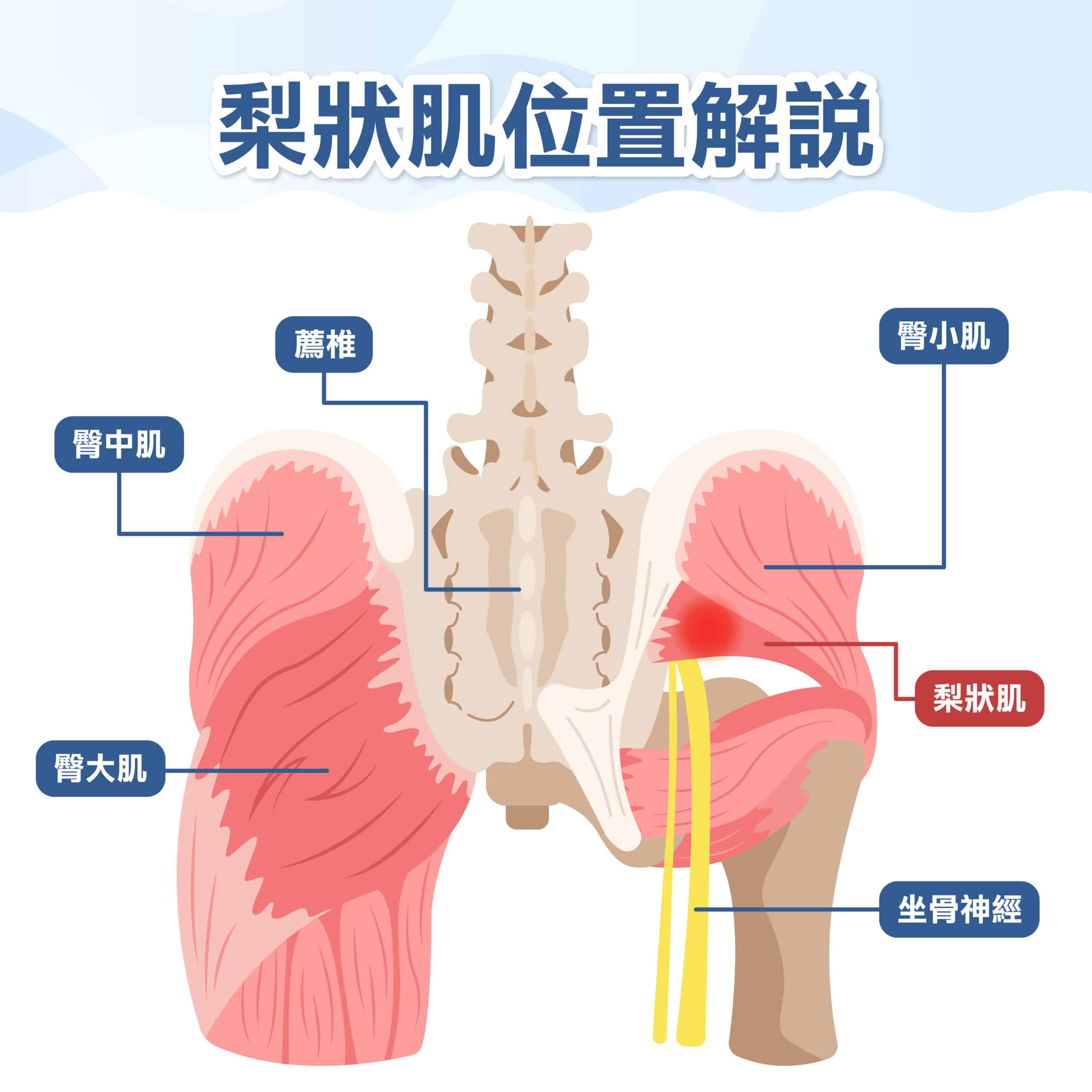 屁股痛恐是梨狀肌症候群！發炎多久會好？要看哪一科？